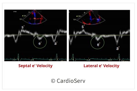 e lv|lv e' septal velocity.